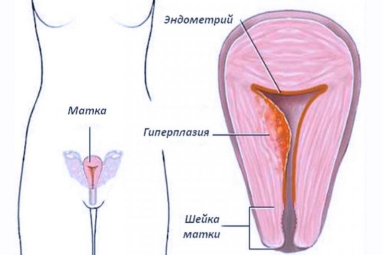 Гиперплазия эндометрия