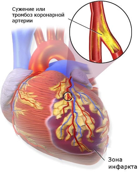 Инфаркт миокарда (ИМ).