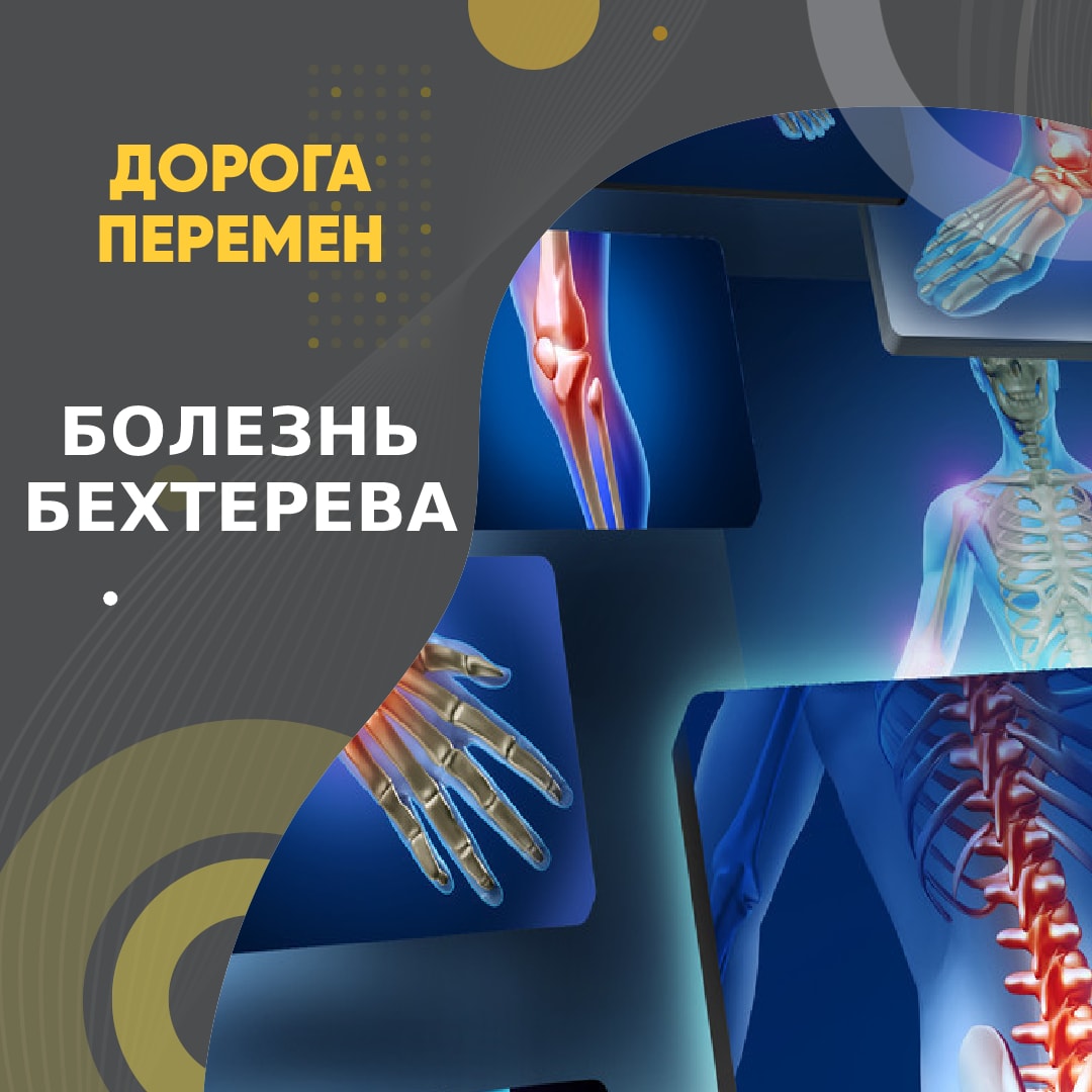 Болезнь Бехтерева.
