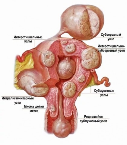 Миома тела матки