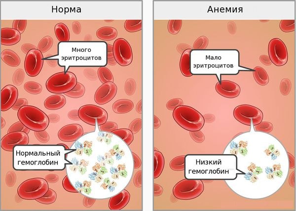 Что нужно знать о железодефицитной анемии