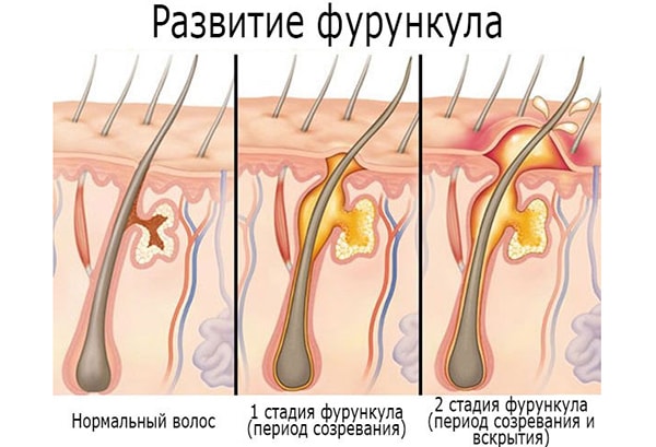 Фурункул